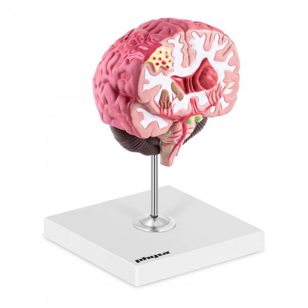 Gehirn Modell - pathologisch - koloriert